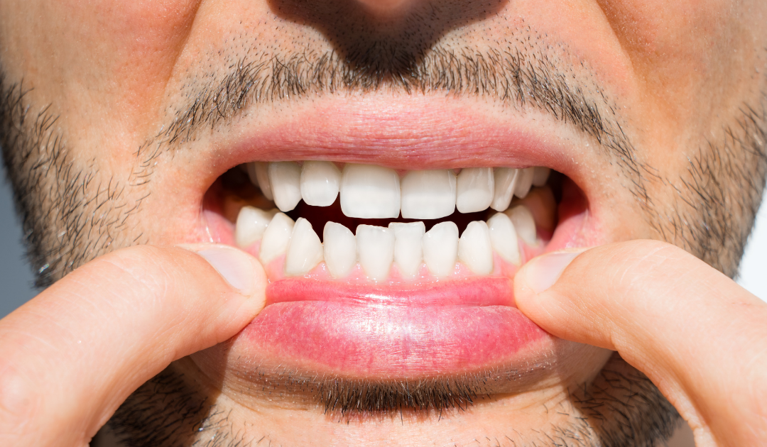 How Crooked Teeth Can Impact Your Health