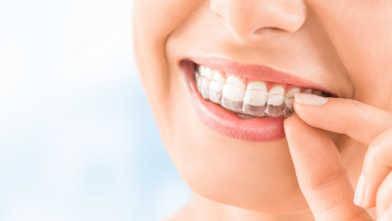 Invisalign® – Invisible Braces - Riverfront Dental