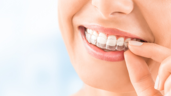 Invisalign® – Invisible Braces