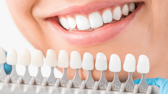 Which Teeth Whitening Method is Best For You?