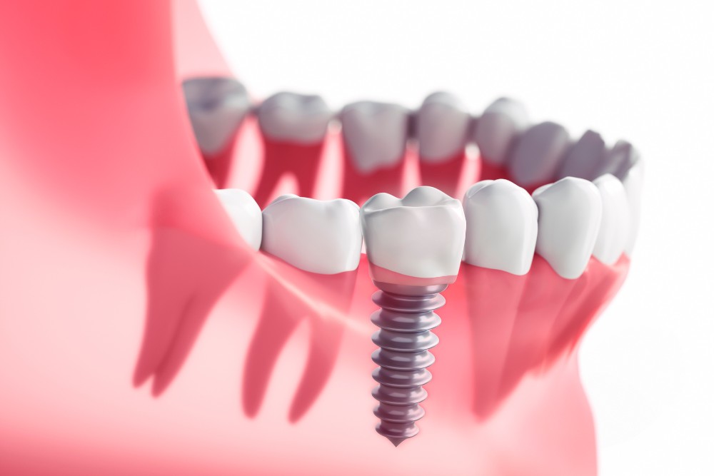 5 Benefits of Choosing Dental Implants