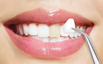 Unveiling the Advantages of Dental Veneers