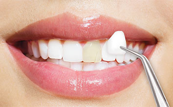 dental veneers