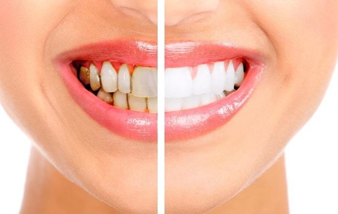 5 Tips to Extend the Results of Your Teeth Whitening