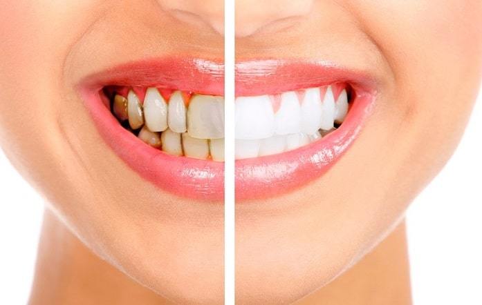 teeth whitening treatment