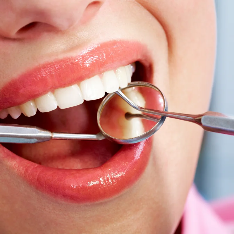 Crown vs filling at Riverfront Dental Cambridge