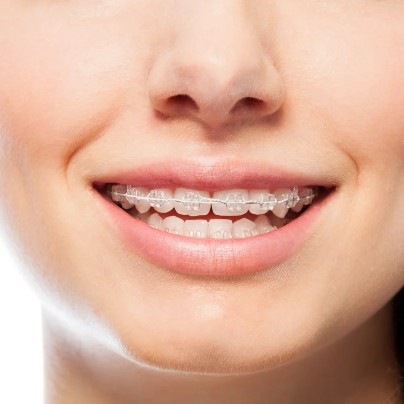 Clear Braces Orthodontic Treatment Riverfront Dental Cambridge Ontario