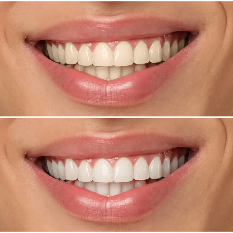 Teeth Whitening Service at Riverfront Dental Cambridge